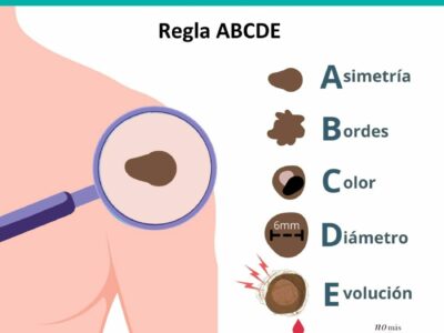 La dermatóloga Irati Allende explica qué es el callo solar y por qué es tan peligroso