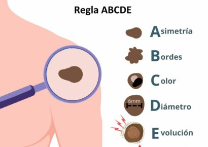 La dermatóloga Irati Allende explica qué es el callo solar y por qué es tan peligroso