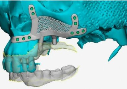 El Dr. Montesdeoca reconstruye el hueso maxilar superior gracias a unos implantes dentales subperiósticos