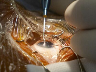 El codirector de FacoElche se somete en directo a la implantación bilateral de una lente diseñada con IA