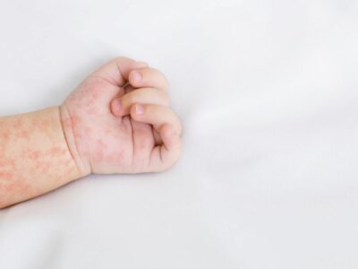 «Es vital mantener actualizado el calendario vacunal para evitar la propagación del sarampión»