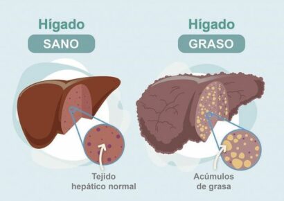 Dr. Juan Arenas, jefe servicio Aparato Digestivo:»Hoy disponemos de un nuevo medio no invasivo para detectar la fibrosis hepática»
