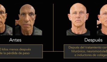 La otra cara del éxito de los GLP-1: el nuevo reto de la medicina estética