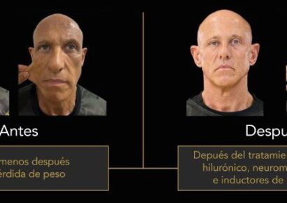 La otra cara del éxito de los GLP-1: el nuevo reto de la medicina estética